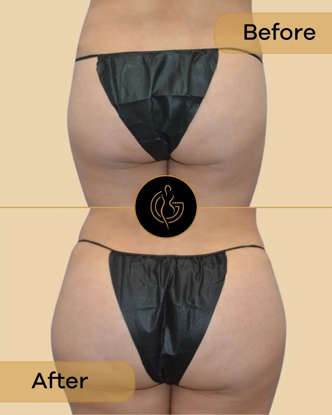 before after bbl bay area california