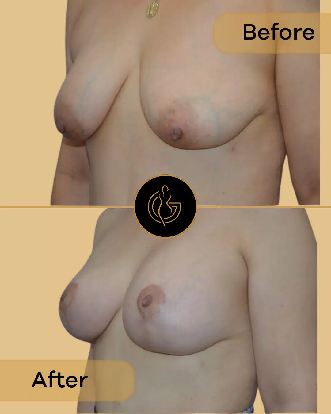 breast lift in the bay area