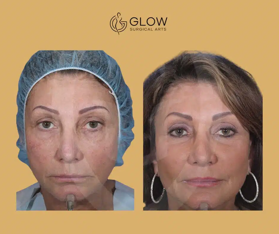 best face fat grafting procedures in the bay area