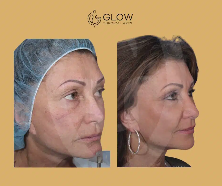 fat transfer to the face specials in the bay area