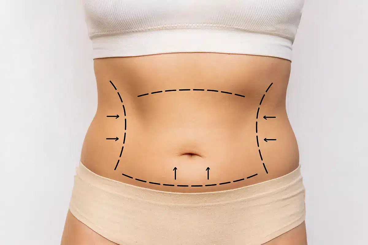 woman's belly with excess fat with marking on her body